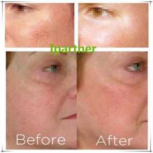 Το Ipartner LS980 Laser Diode ανακουφίζει το σύστημα ερυθρότητας