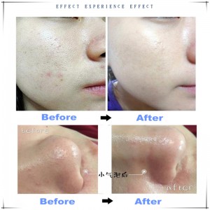 Ιρλανδός Υδρογόνο οξυγόνο μικρή φυσαλίδα υδρόφραγμα 6 σε 1 πολυλειτουργικό καθαριστικό δέρματος